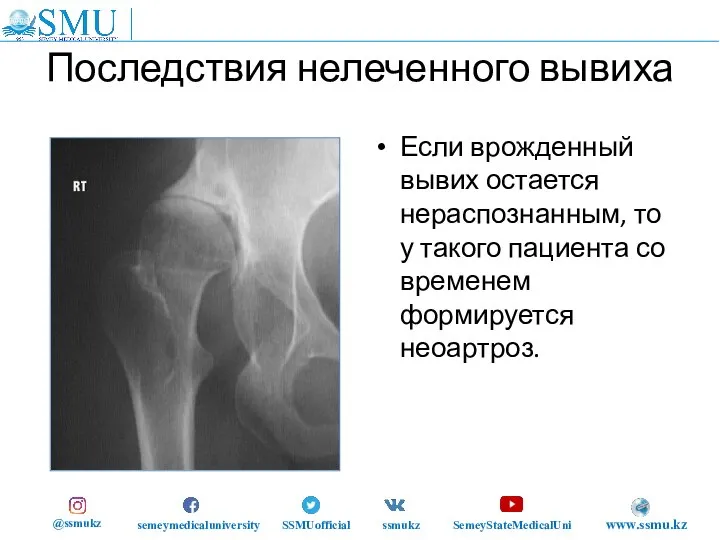 Последствия нелеченного вывиха Если врожденный вывих остается нераспознанным, то у такого пациента