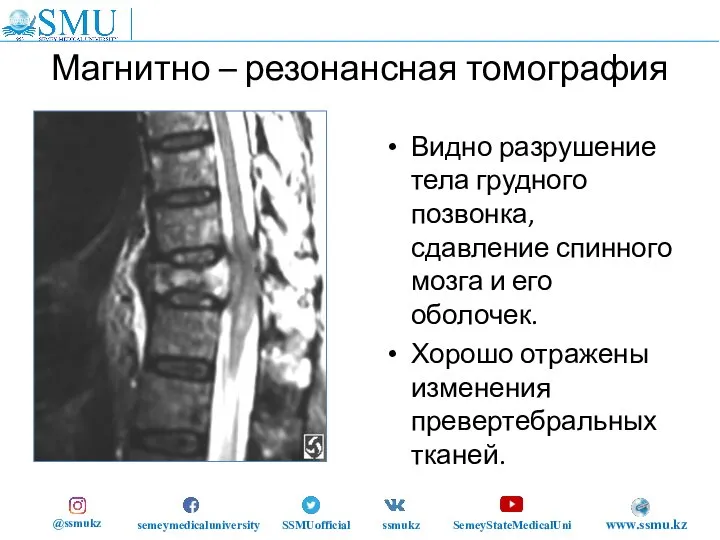 Магнитно – резонансная томография Видно разрушение тела грудного позвонка, сдавление спинного мозга