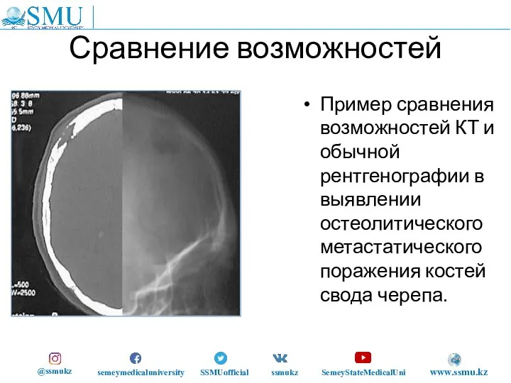 Сравнение возможностей Пример сравнения возможностей КТ и обычной рентгенографии в выявлении остеолитического