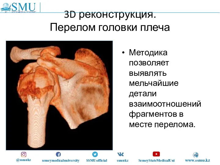 3D реконструкция. Перелом головки плеча Методика позволяет выявлять мельчайшие детали взаимоотношений фрагментов