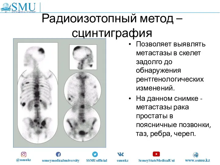 Радиоизотопный метод – сцинтиграфия Позволяет выявлять метастазы в скелет задолго до обнаружения