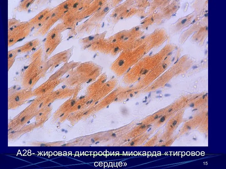 А28- жировая дистрофия миокарда «тигровое сердце»