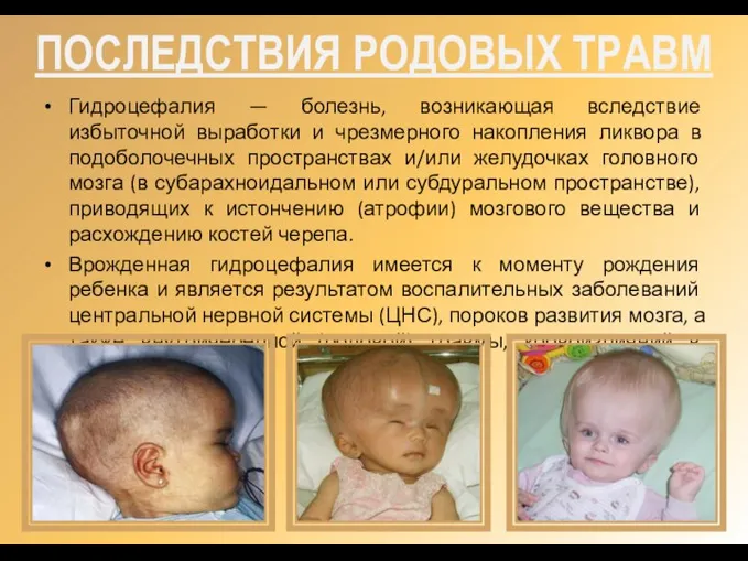 ПОСЛЕДСТВИЯ РОДОВЫХ ТРАВМ Гидроцефалия — болезнь, возникающая вследствие избыточной выработки и чрезмерного