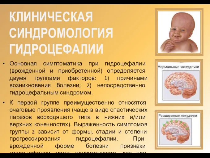 КЛИНИЧЕСКАЯ СИНДРОМОЛОГИЯ ГИДРОЦЕФАЛИИ Основная симптоматика при гидроцефалии (врожденной и приобретенной) определяется двумя