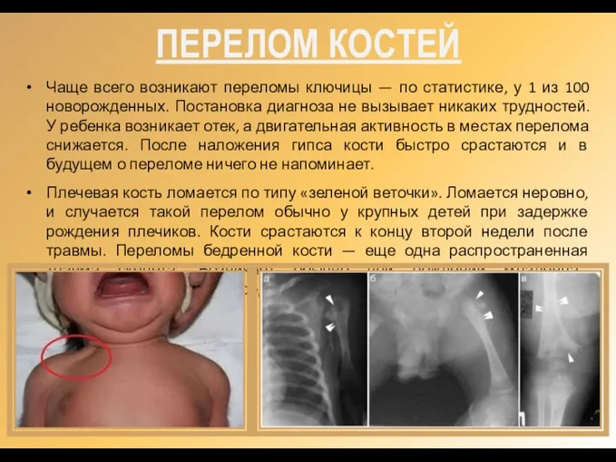 ПЕРЕЛОМ КОСТЕЙ Чаще всего возникают переломы ключицы — по статистике, у 1