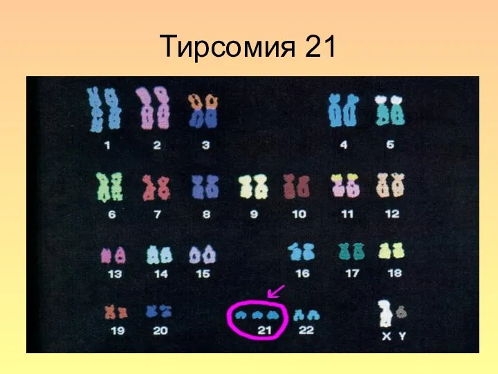 Тирсомия 21