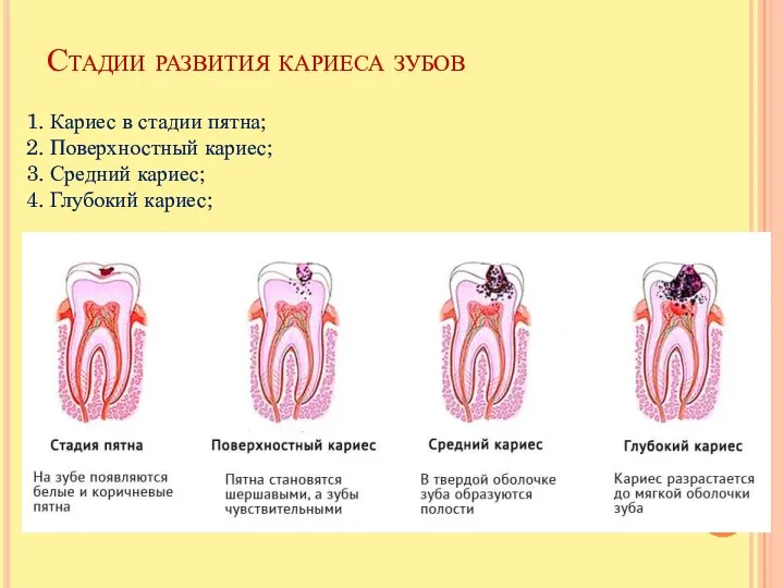 Стадии развития кариеса зубов 1. Кариес в стадии пятна; 2. Поверхностный кариес;