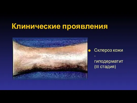 Клинические проявления Склероз кожи - гиподерматит (III стадия)