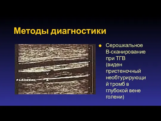 Методы диагностики Серошкальное В-сканирование при ТГВ (виден пристеночный необтурирующий тромб в глубокой вене голени)