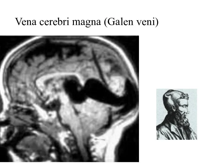 Vena cerebri magna (Galen veni)