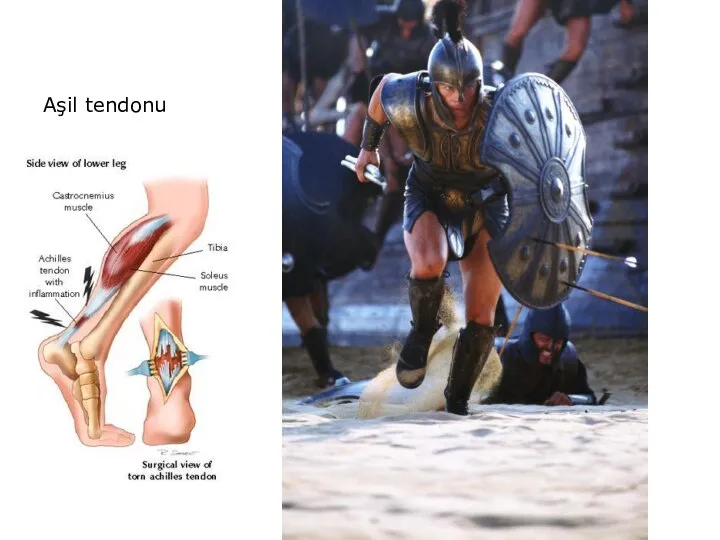 Aşil tendonu