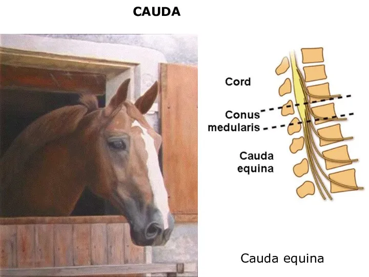 CAUDA Cauda equina