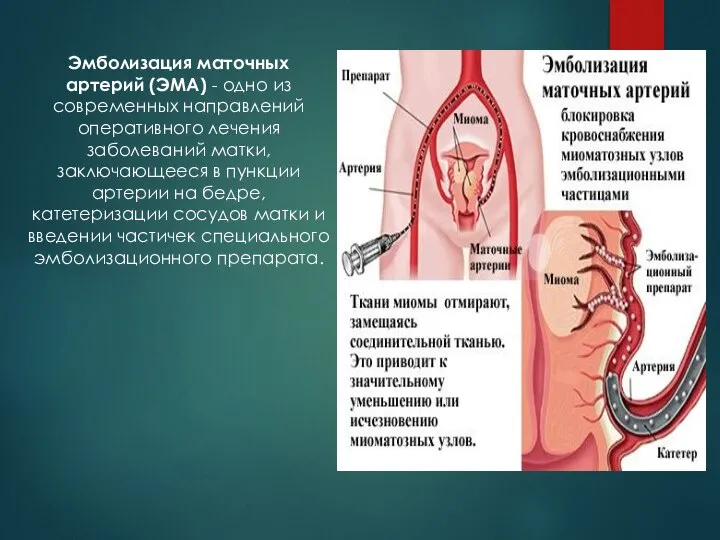 Эмболизация маточных артерий (ЭМА) - одно из современных направлений оперативного лечения заболеваний
