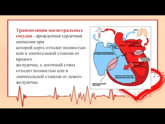 Транспозиция магистральных сосудов - врожденная сердечная аномалия при которой аорта отходит полностью