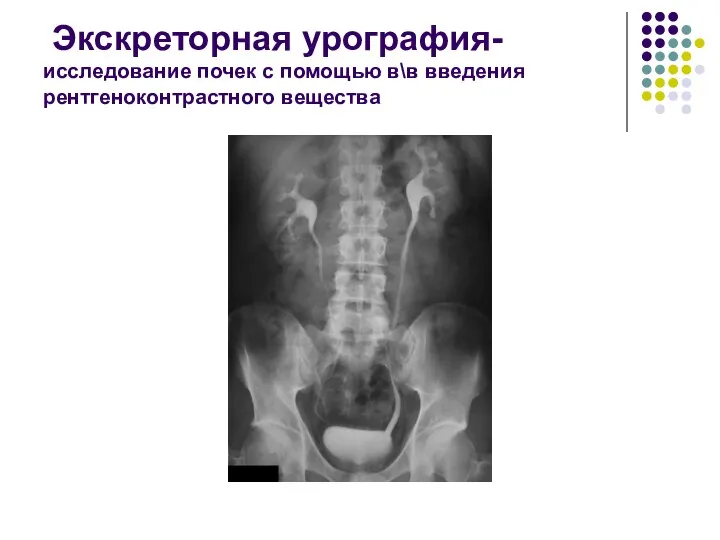 Экскреторная урография-исследование почек с помощью в\в введения рентгеноконтрастного вещества