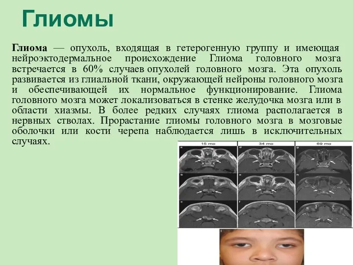 Глиомы Глиома — опухоль, входящая в гетерогенную группу и имеющая нейроэктодермальное происхождение