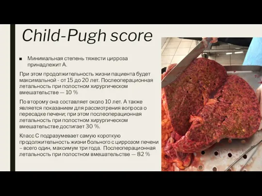 Child-Pugh score Минимальная степень тяжести цирроза принадлежит А. При этом продолжительность жизни