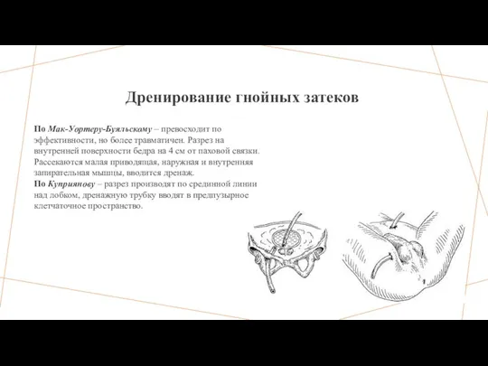 Дренирование гнойных затеков По Мак-Уортеру-Буяльскому – превосходит по эффективности, но более травматичен.