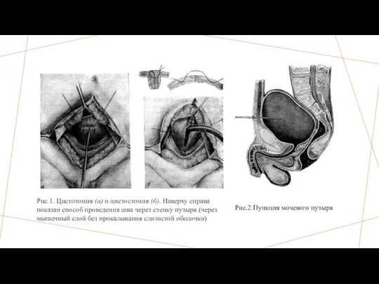Рис.1. Цистотомия (а) и цистостомия (б). Наверху справа показан способ проведе­ния шва