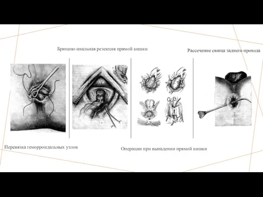 Перевязка геморроидальных узлов Операции при выпадении прямой кишки Рассечение свища заднего прохода Брюшно-анальная резекция прямой кишки