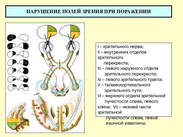 НАРУШЕНИЕ ПОЛЕЙ ЗРЕНИЯ ПРИ ПОРАЖЕНИИ I – зрительного нерва; II – внутренних