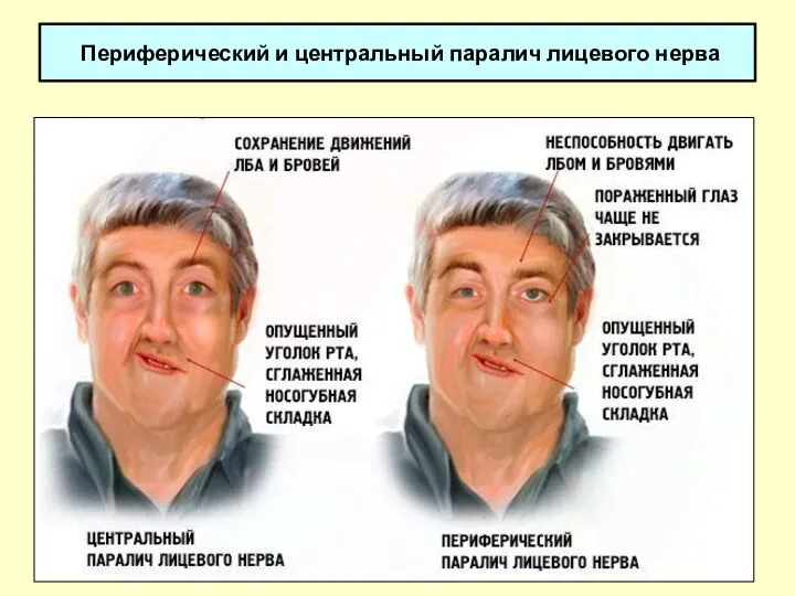 Периферический и центральный паралич лицевого нерва