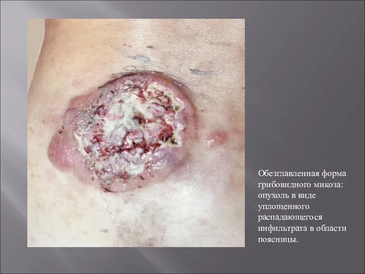 Обезглавленная форма грибовидного микоза: опухоль в виде уплощенного распадающегося инфильтрата в области поясницы.