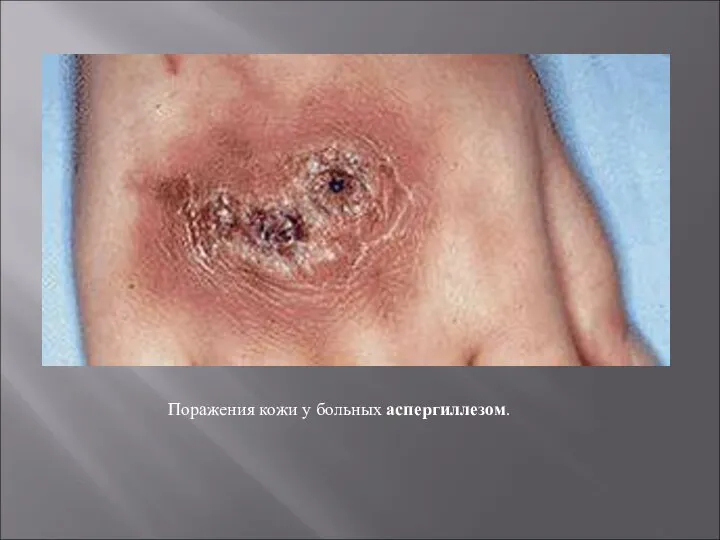 Поражения кожи у больных аспергиллезом.