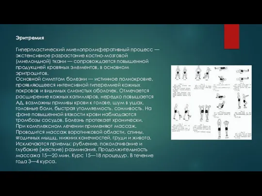 Эритремия Гиперпластический миелопролиферативный процесс — экстенсивное разрастание костно-мозговой (миелоидной) ткани — сопровождается