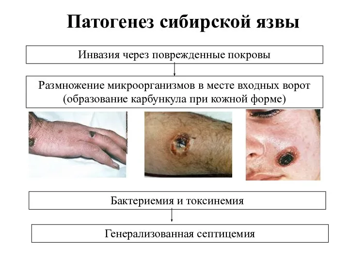 Патогенез сибирской язвы Инвазия через поврежденные покровы Размножение микроорганизмов в месте входных