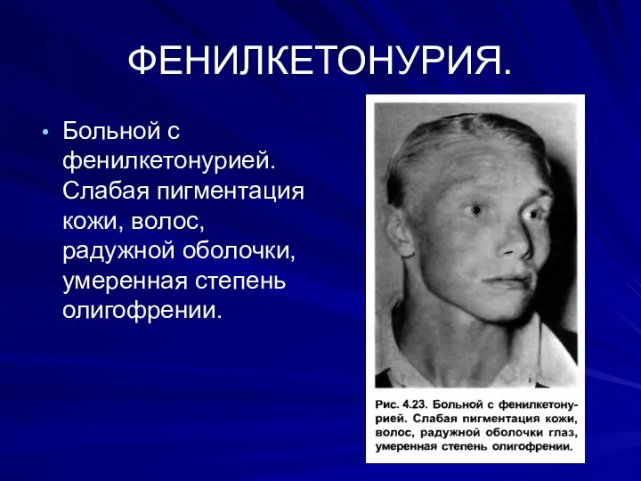 ФЕНИЛКЕТОНУРИЯ. Больной с фенилкетонурией. Слабая пигментация кожи, волос, радужной оболочки, умеренная степень олигофрении.