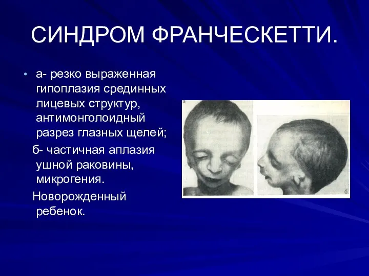 СИНДРОМ ФРАНЧЕСКЕТТИ. а- резко выраженная гипоплазия срединных лицевых структур, антимонголоидный разрез глазных