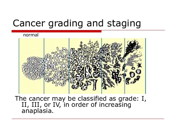 Cancer grading and staging The cancer may be classified as grade: I,