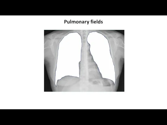 Pulmonary fields