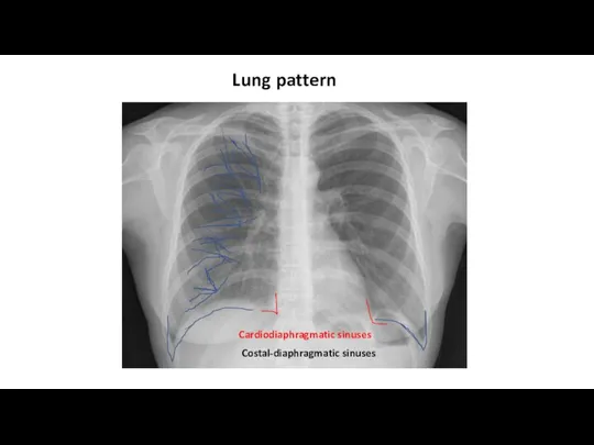 Costal-diaphragmatic sinuses Lung pattern Cardiodiaphragmatic sinuses