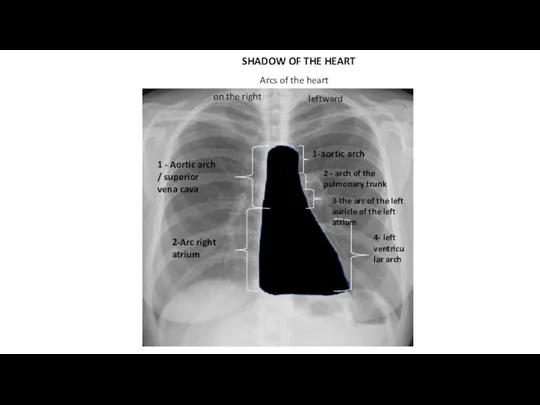 SHADOW OF THE HEART 1 - Aortic arch / superior vena cava