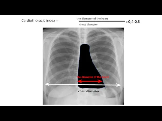 Cardiothoracic index = the diameter of the heart chest diameter = 0,4-0,5