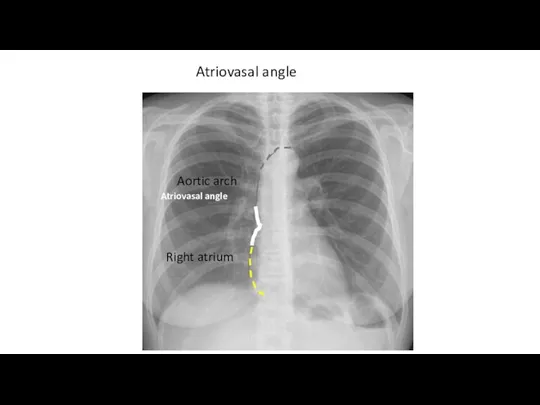 Atriovasal angle Aortic arch Right atrium Atriovasal angle