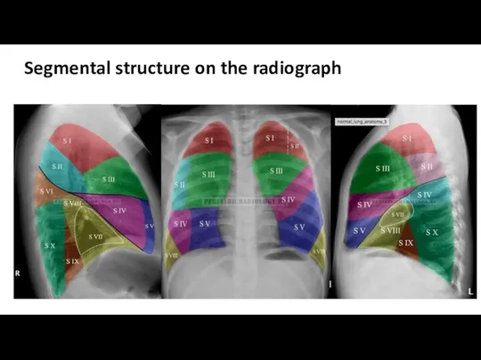 Segmental structure on the radiograph