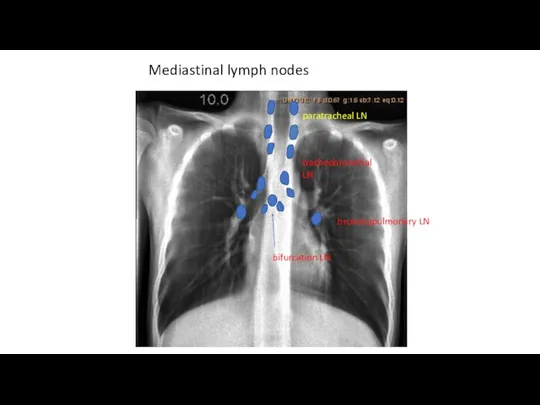 Mediastinal lymph nodes paratracheal LN bronchopulmonary LN tracheobronchial LN bifurcation LN