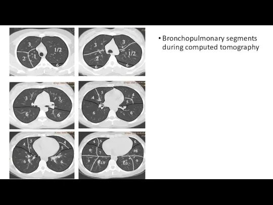 Bronchopulmonary segments during computed tomography