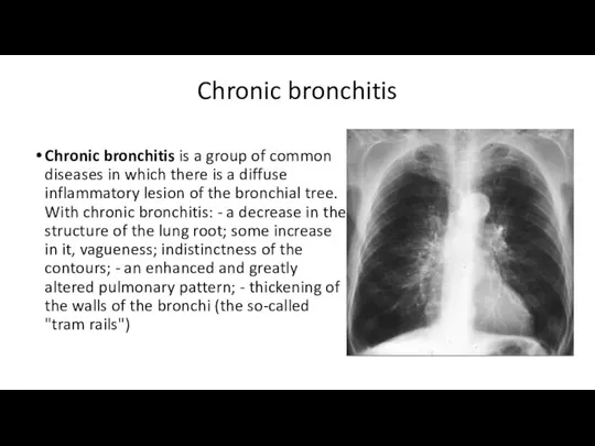 Chronic bronchitis Chronic bronchitis is a group of common diseases in which