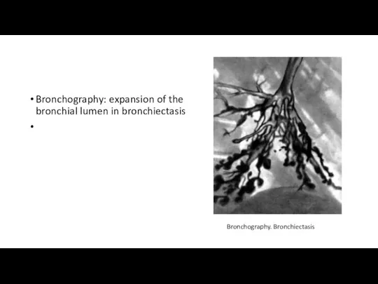 Bronchography: expansion of the bronchial lumen in bronchiectasis Bronchography. Bronchiectasis