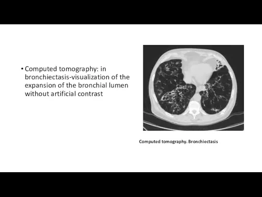 Computed tomography: in bronchiectasis-visualization of the expansion of the bronchial lumen without