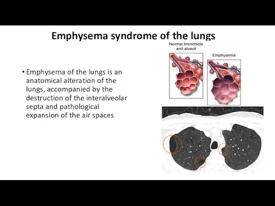 Emphysema syndrome of the lungs Emphysema of the lungs is an anatomical