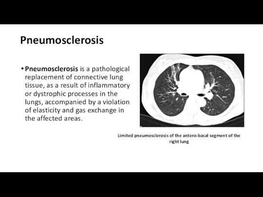 Pneumosclerosis Pneumosclerosis is a pathological replacement of connective lung tissue, as a