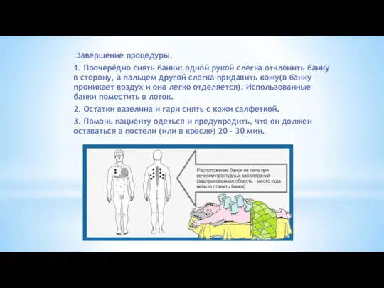 Завершение процедуры. 1. Поочерёдно снять банки: одной рукой слегка отклонить банку в