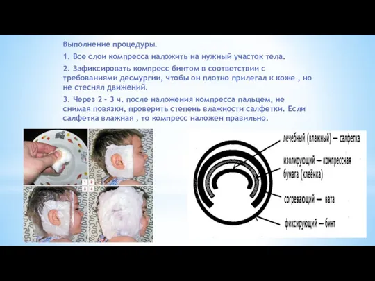 Выполнение процедуры. 1. Все слои компресса наложить на нужный участок тела. 2.