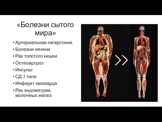 «Болезни сытого мира» Артериальная гипертония Болезни печени Рак толстого кишки Остеоартроз Инсульт