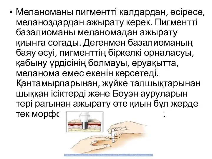 Меланоманы пигментті қалдардан, әсіресе, меланоздардан ажырату керек. Пигментті базалиоманы меланомадан ажырату қиынға